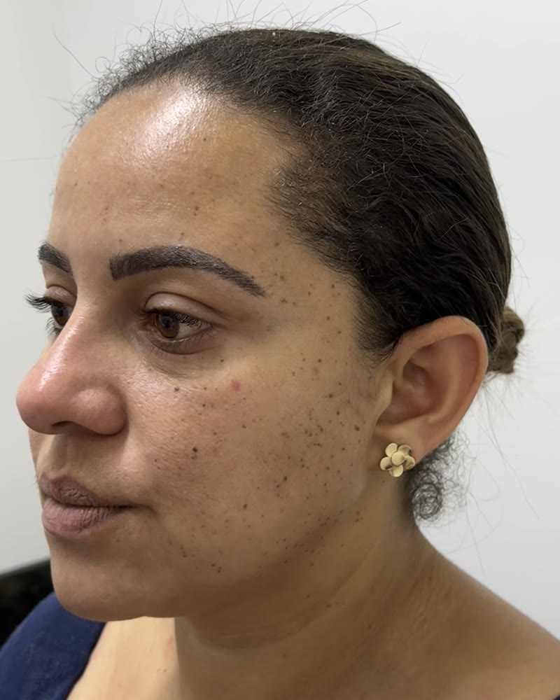 Michele — registro de perfil esquerdo da pele