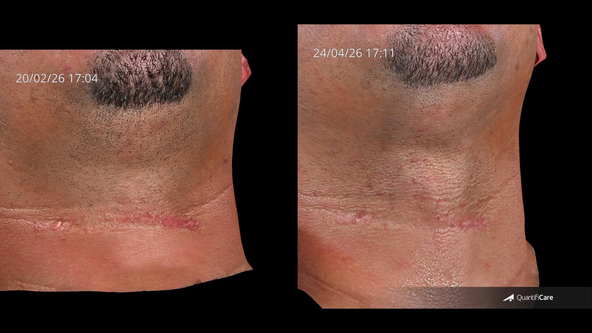 Antes e depois — Cicatriz no pescoço — depois