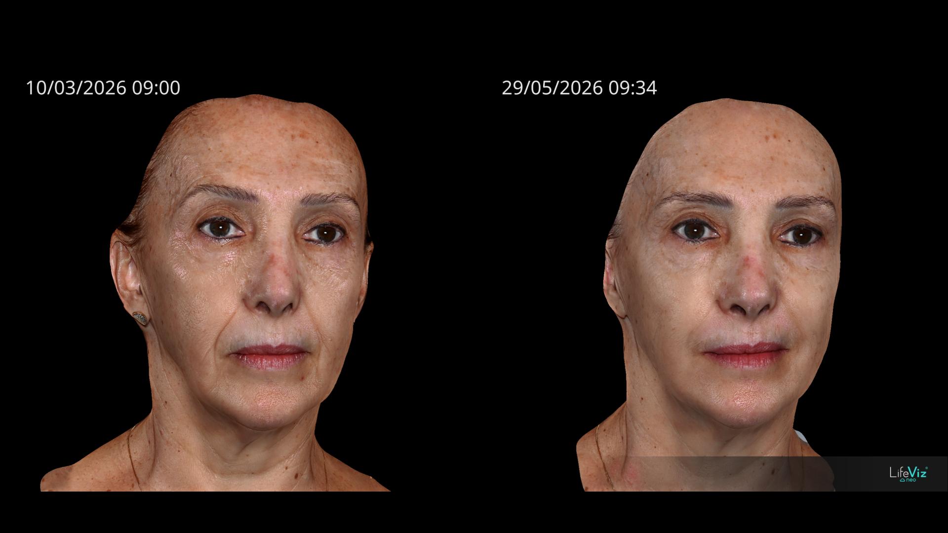 Antes e depois — Renovação completa da pele — depois